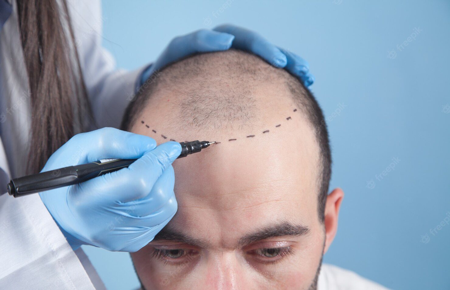 Prix moyen d’une greffe de cheveux