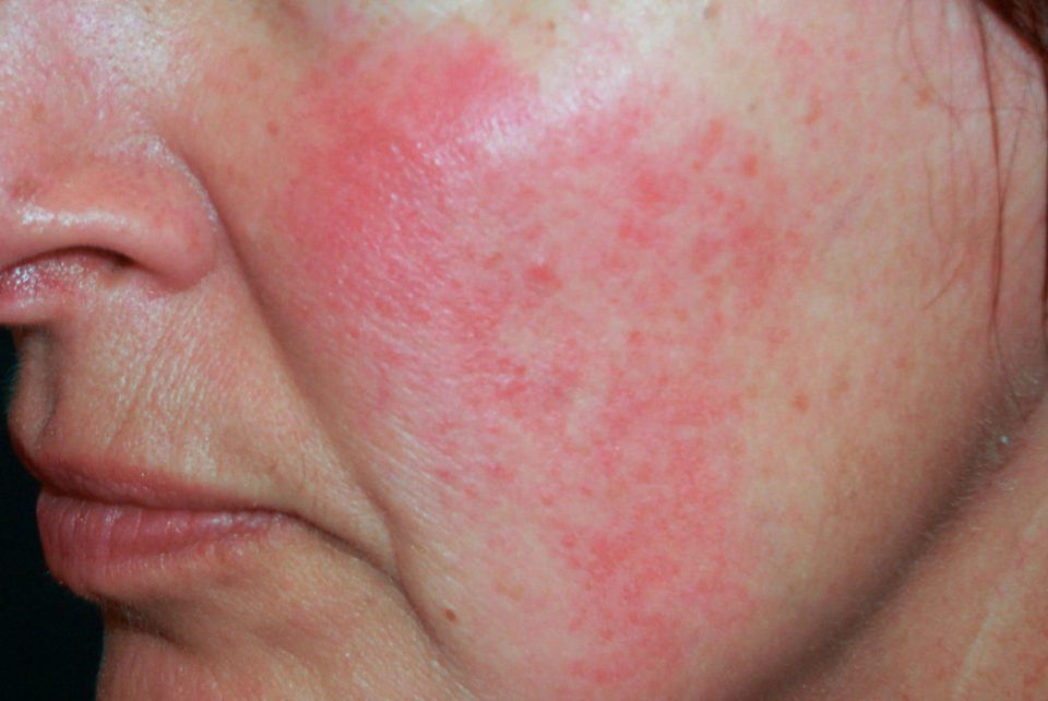 Problèmes d’acné