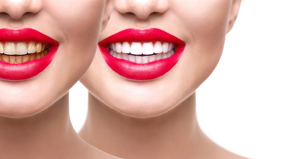dents plus blanches pour un sourire parfait