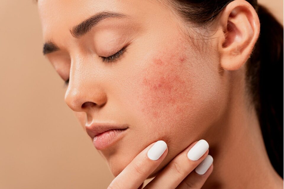 produits anti-acné